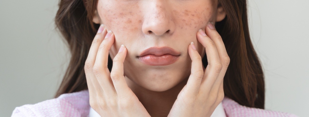 Dark Spot Removal in Tokyo, Japan:Recommended Clinics