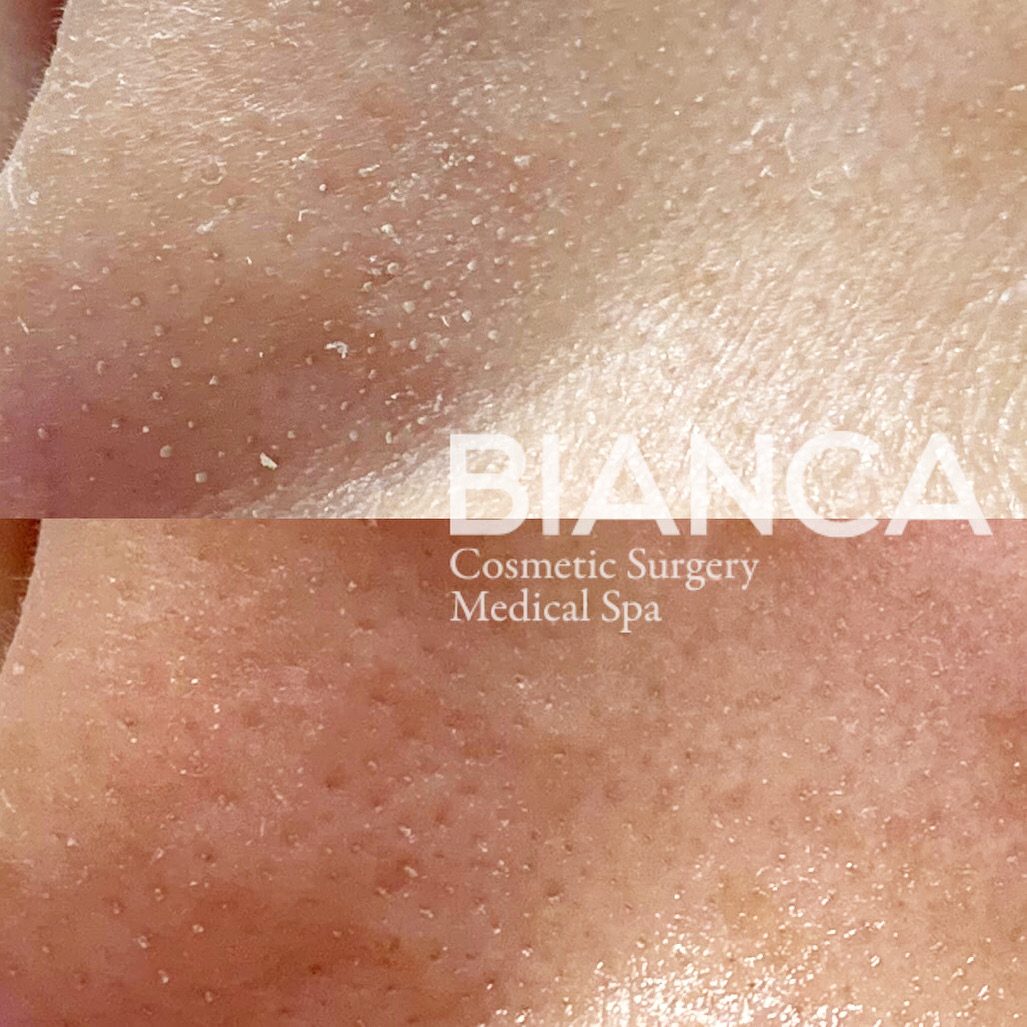 The True Value of Hydrafacial: Why Skin Preparation Matters in Modern Aesthetic Treatments