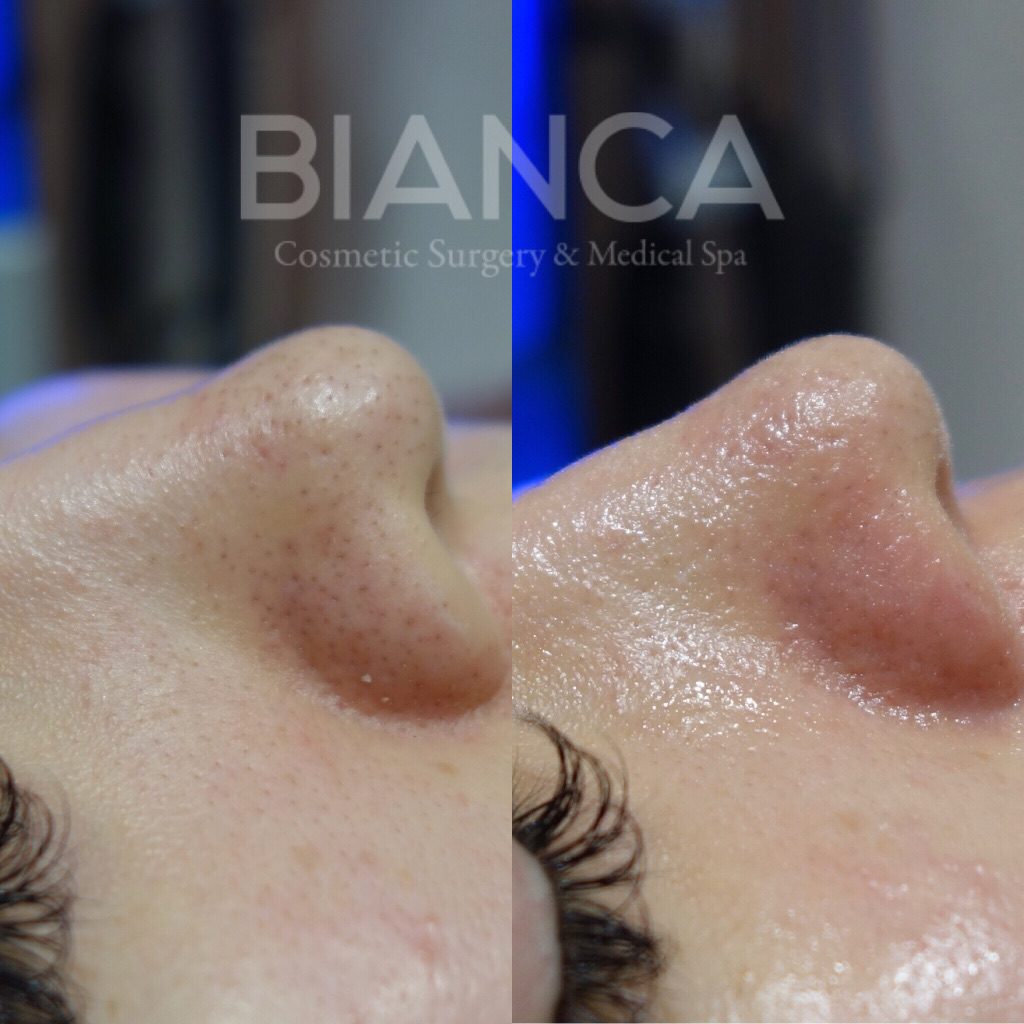 The True Value of Hydrafacial: Why Skin Preparation Matters in Modern Aesthetic Treatments