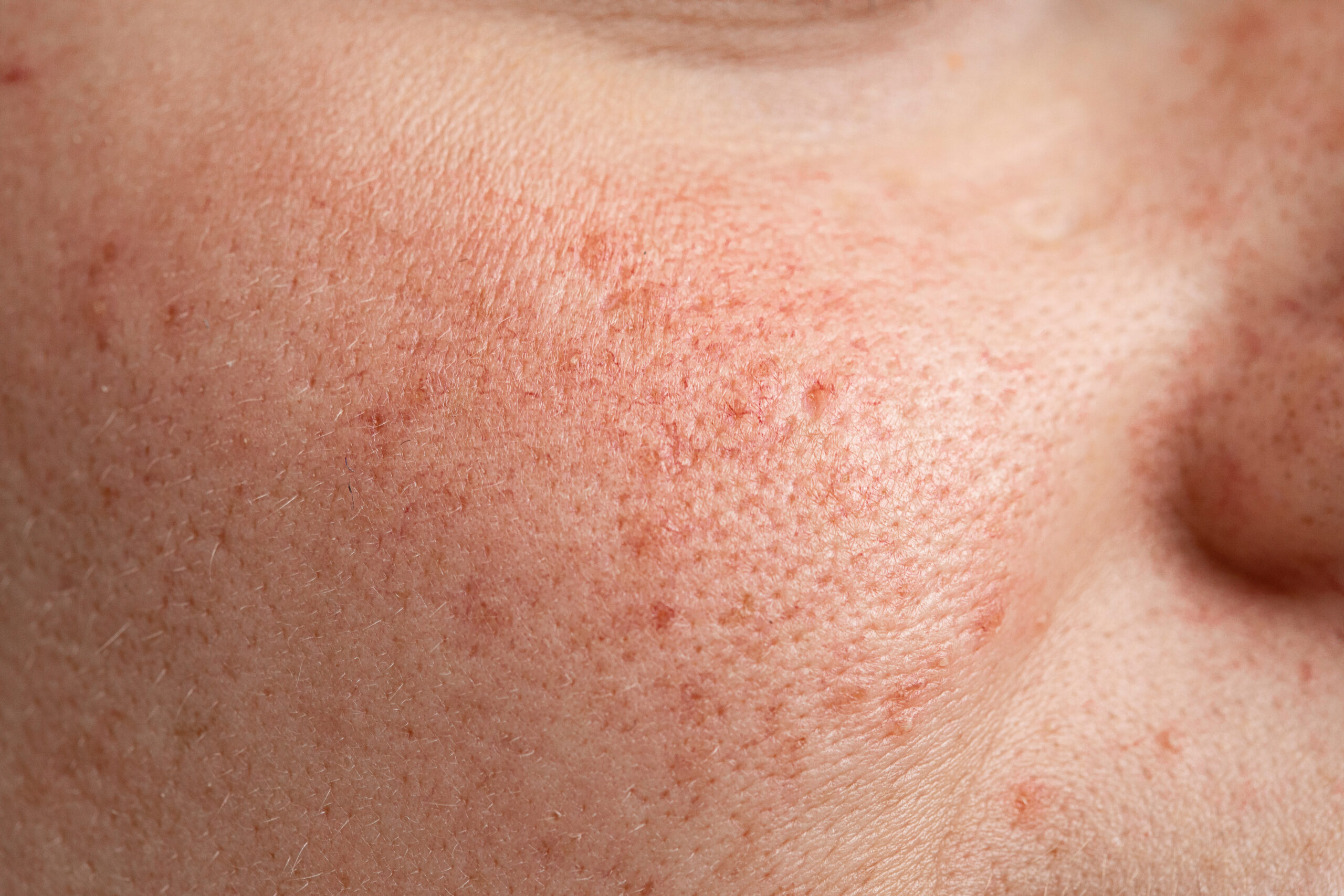 `alt="Skin of a woman showing symptoms similar to melasma"`