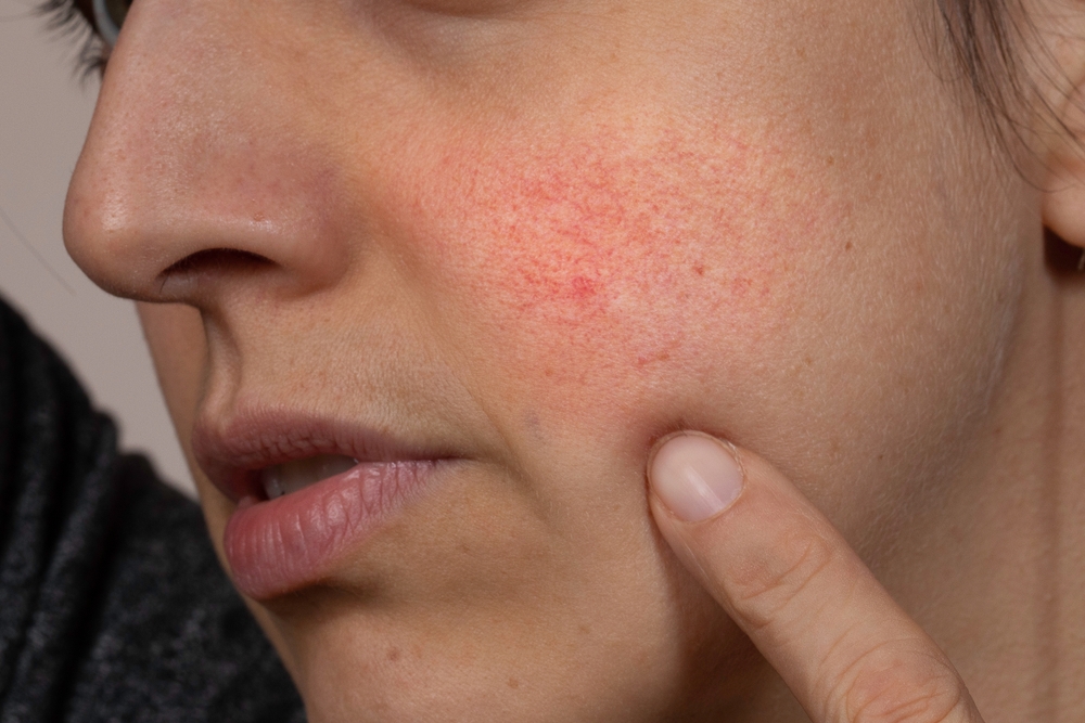 Woman pointing to redness on her cheeks caused by rosacea.