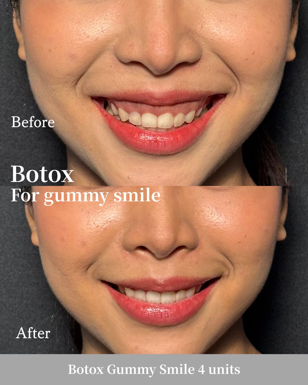Before-and-After Photos of Botox Injections at Bibi Clinic