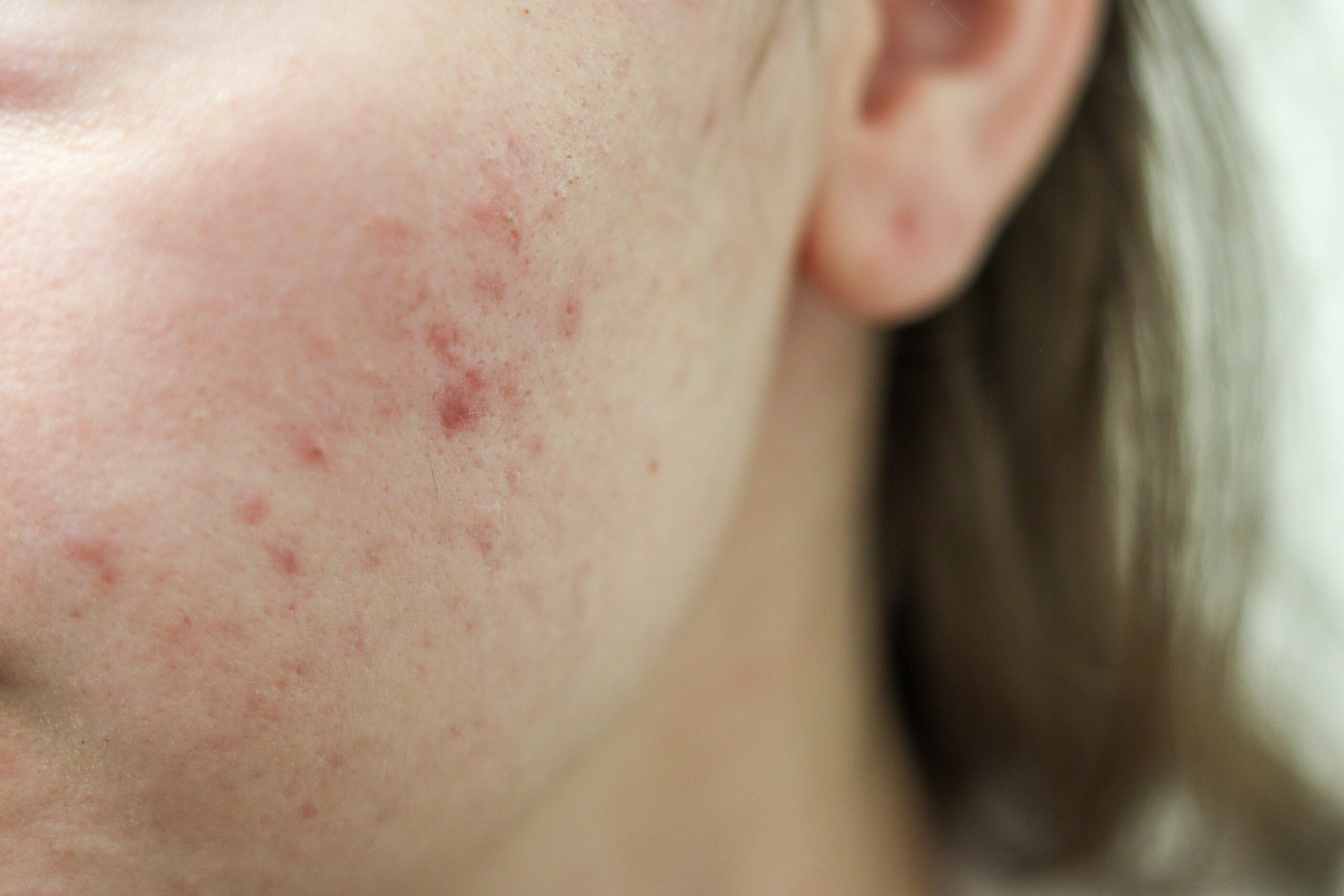 Acne scars