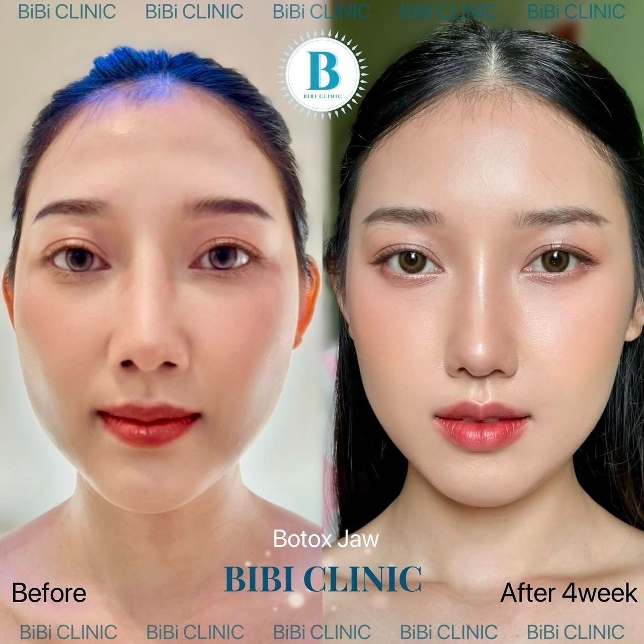 Botox before and after photos