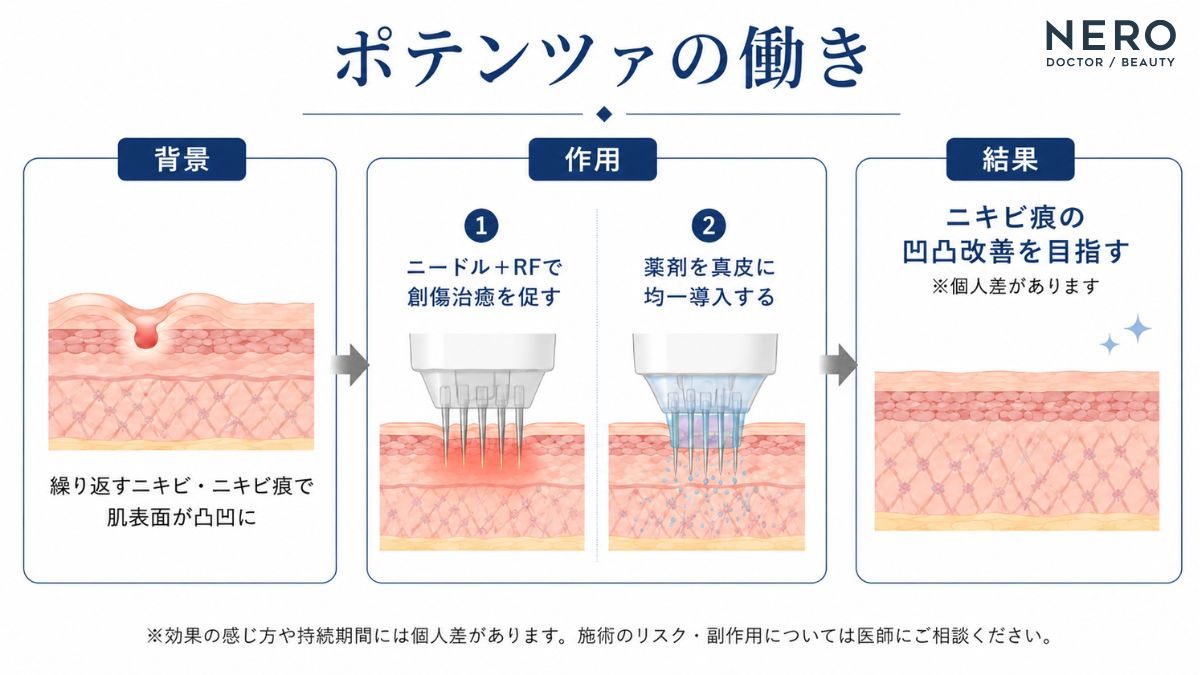 ポテンツァによるニキビ痕改善の仕組みをまとめたメカニズム図