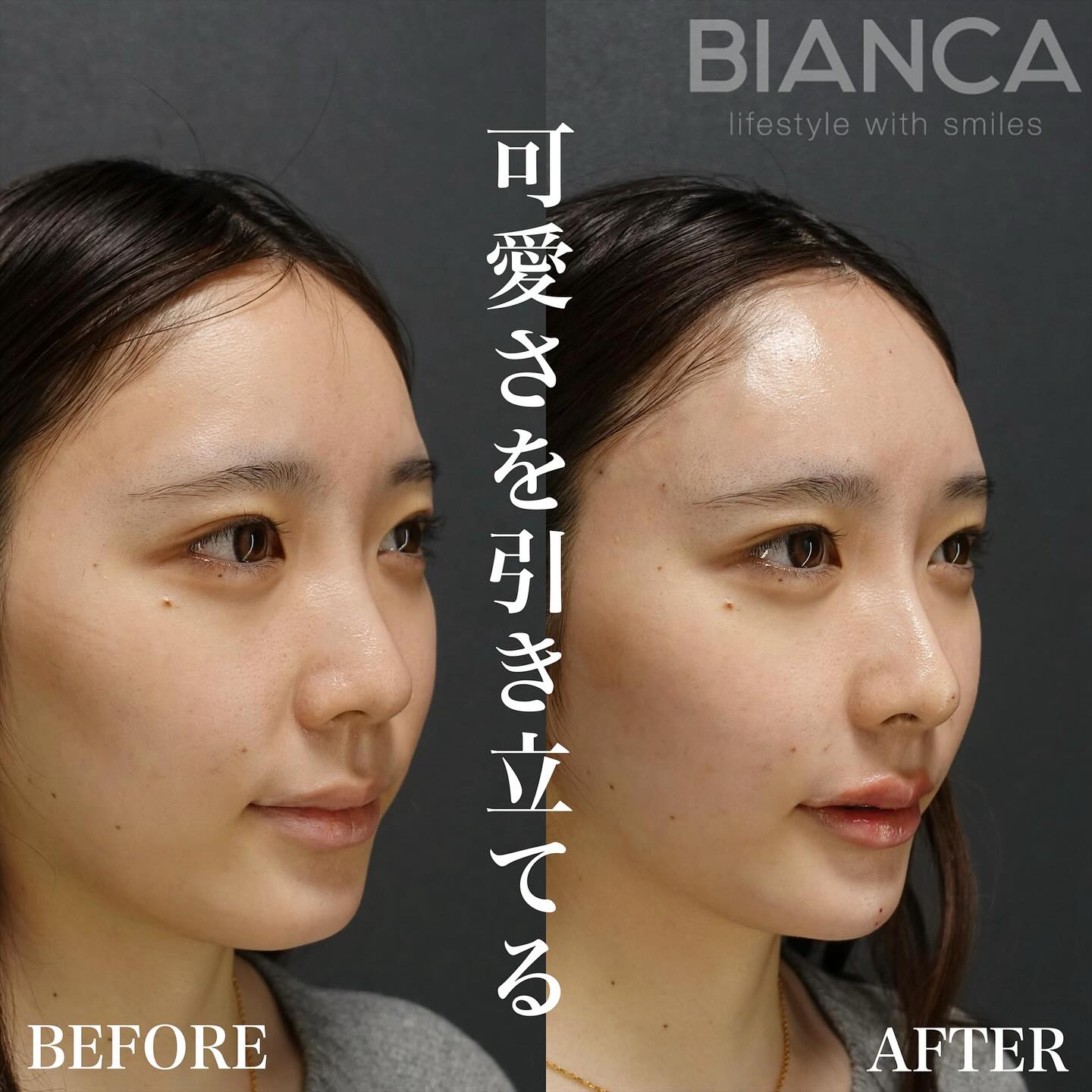 カスタマイズヒアルで話題の紀田ドクターが受け継ぐBIANCA式ヒアルロン酸メソッドとは？