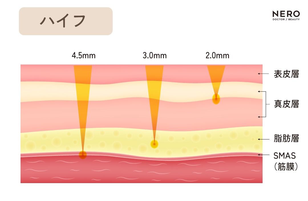 ハイフ　名器形成で外イキも中イキもできるカラダに！膣の引き締めだけじゃない名器の作り方｜NERO DOCTOR / BEAUTY（美容医療）