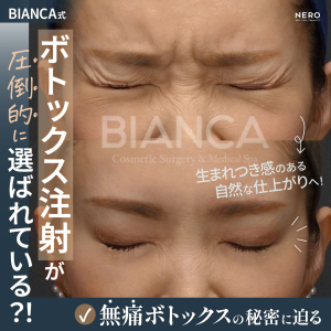 ビアンカ式無痛ボトックスのススメ！ストレスのない施術と自然で失敗しない仕上がりの秘訣