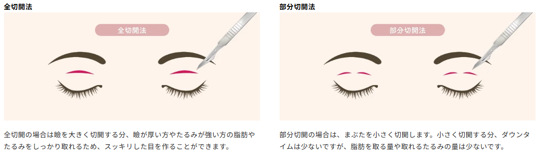 HAAB　二重　HAABクリニック　HAABクリニック切開法の違い