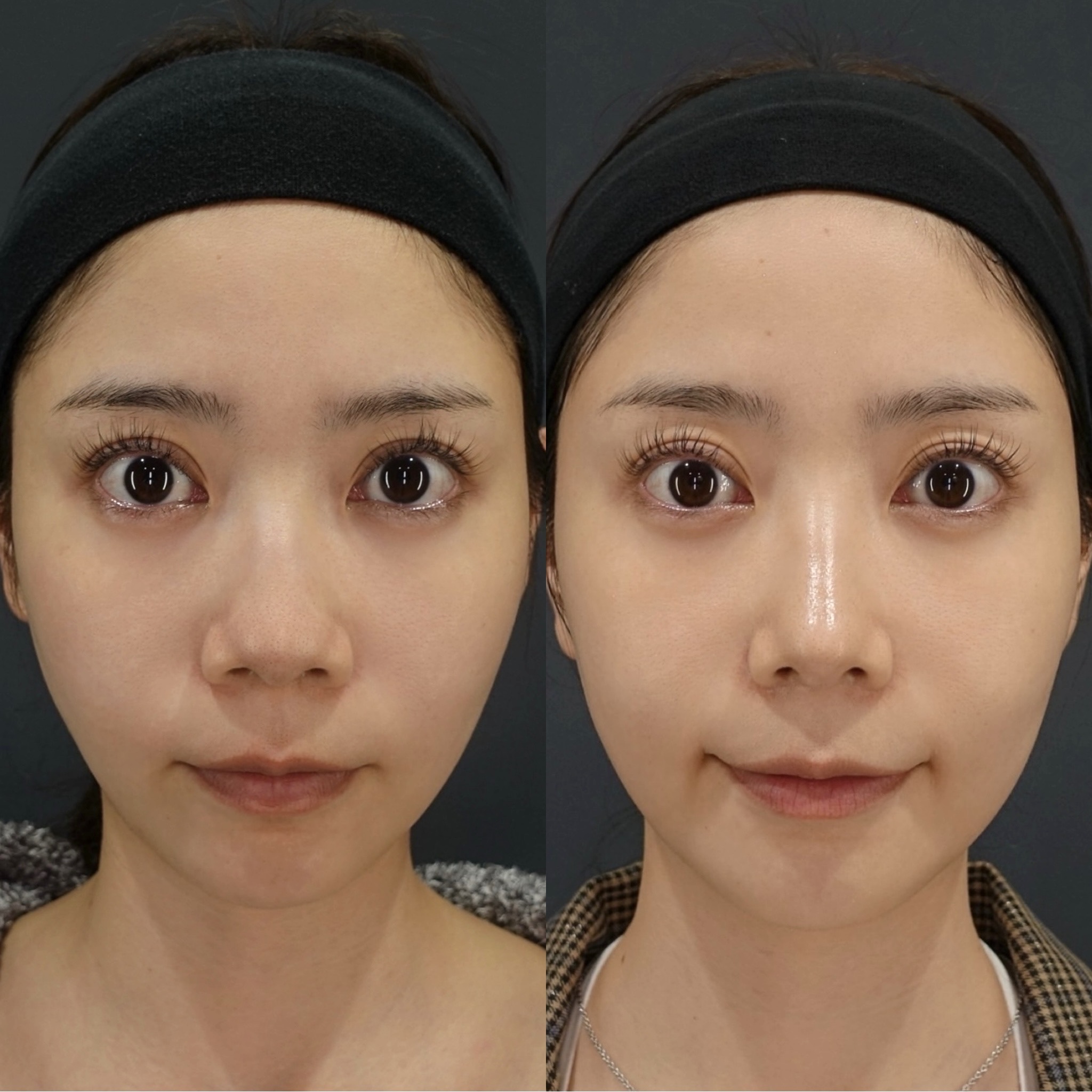 鼻のコンプレックスを自信に！LIVIN CLINIC新行内先生と考える後悔しない鼻整形の選び方｜NERO DOCTOR / BEAUTY（美容医療）