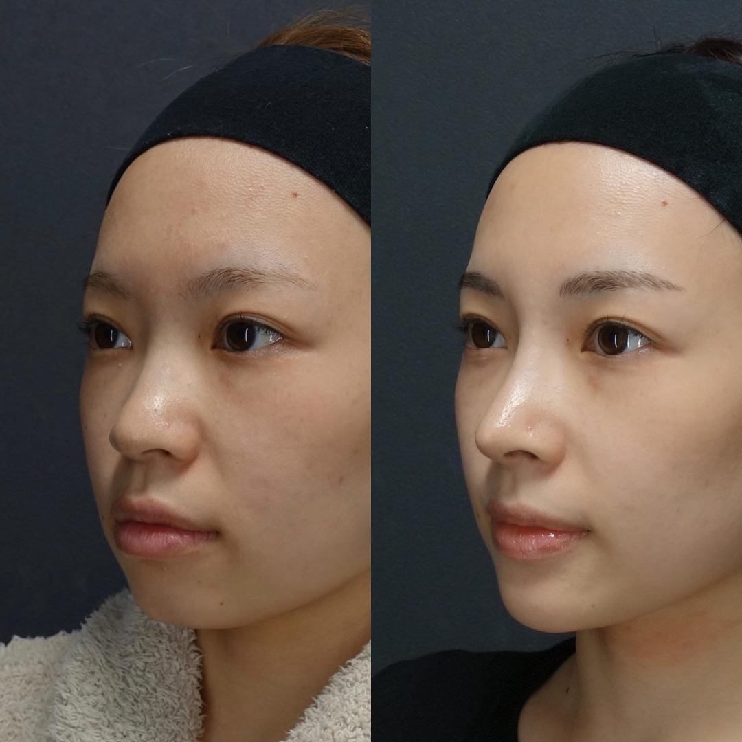 鼻のコンプレックスを自信に!LIVIN CLINIC新行内先生と考える後悔しない鼻整形の選び方|NERO DOCTOR / BEAUTY(美容医療)