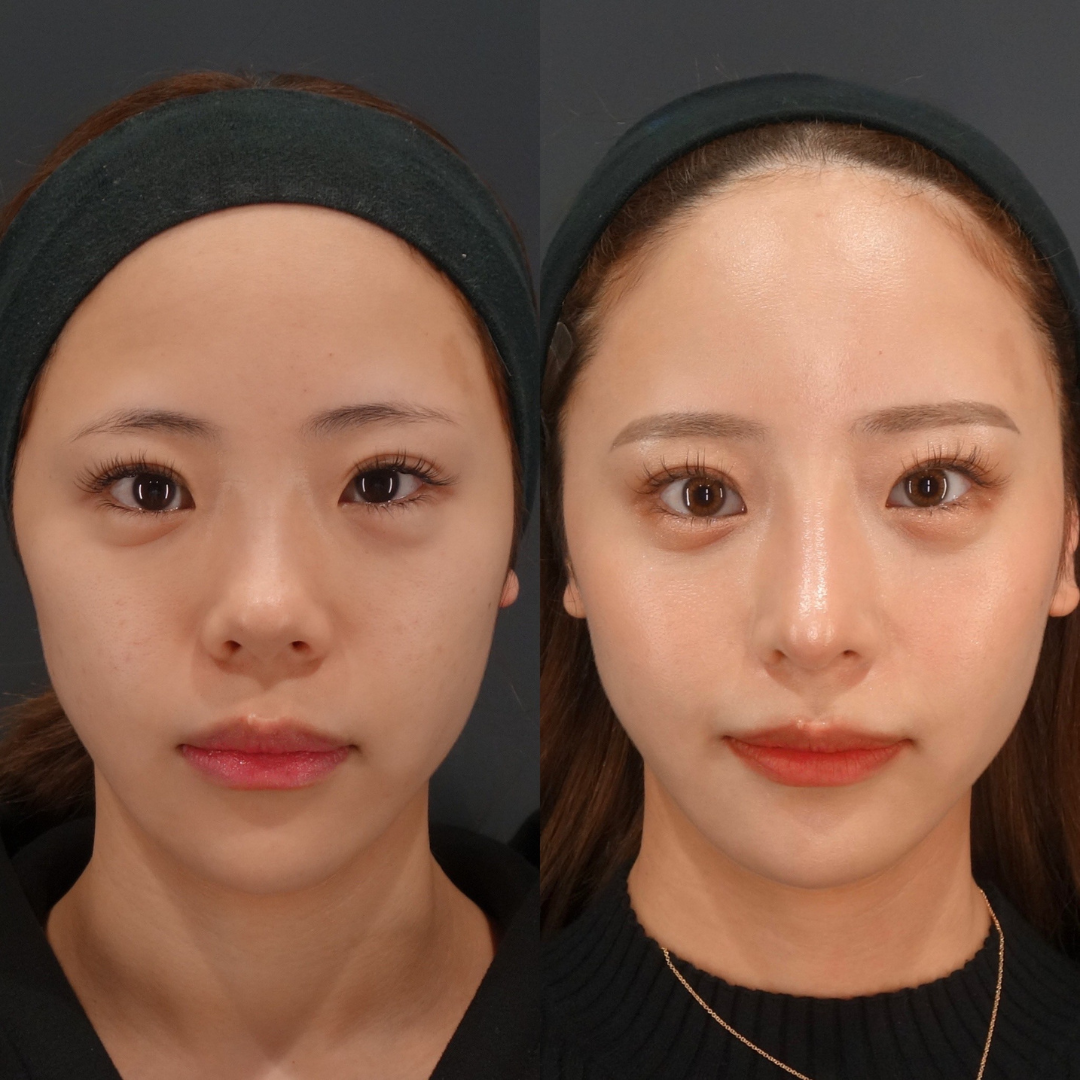 鼻のコンプレックスを自信に！LIVIN CLINIC新行内先生と考える後悔しない鼻整形の選び方｜NERO DOCTOR / BEAUTY（美容医療）