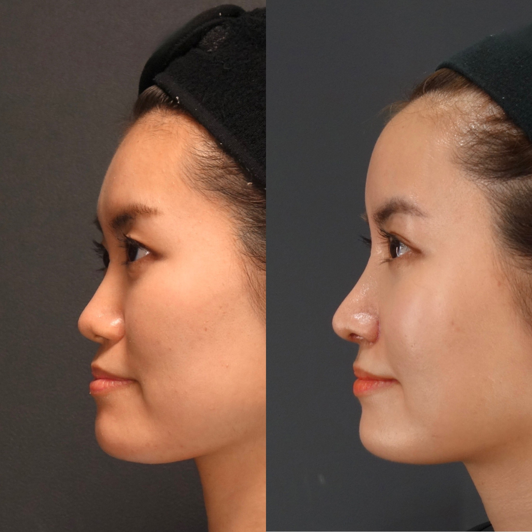 鼻のコンプレックスを自信に！LIVIN CLINIC新行内先生と考える後悔しない鼻整形の選び方｜NERO DOCTOR / BEAUTY（美容医療）