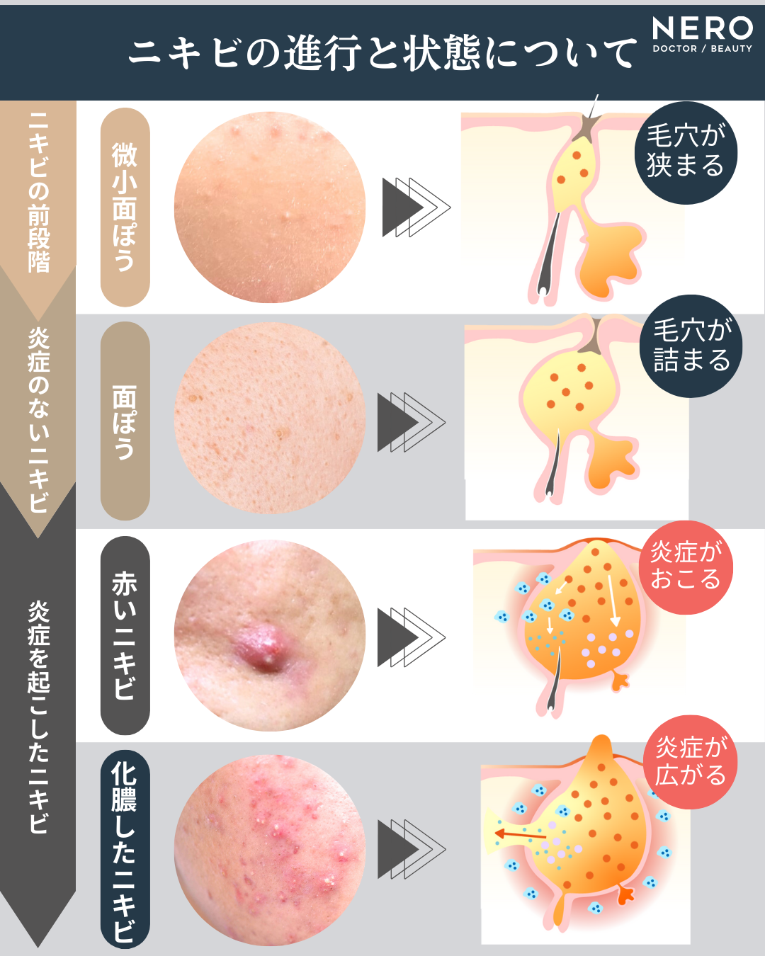 金沢 ニキビ跡 レーザー とりい皮膚科クリニック ニキビやの第一歩は保険診療から！ (1)