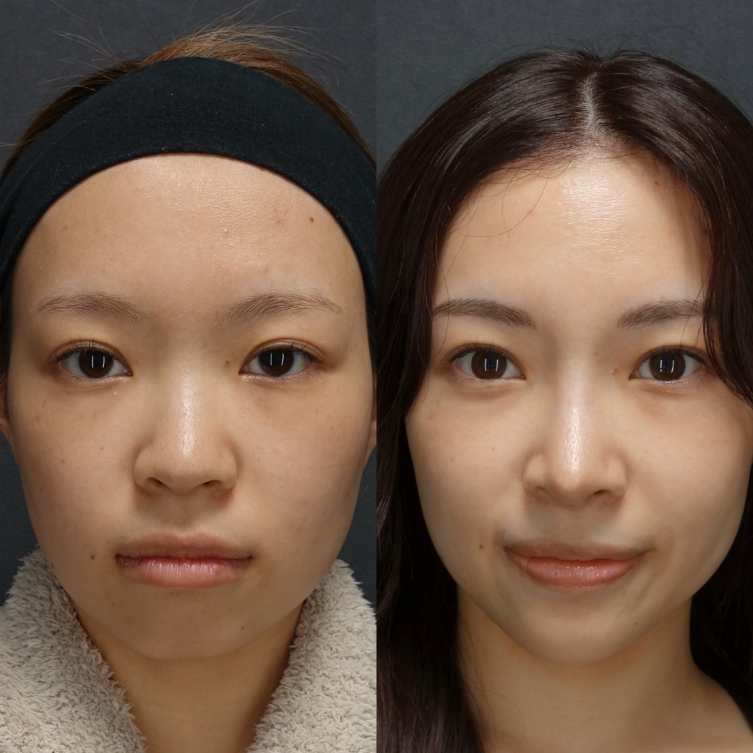鼻のコンプレックスを自信に！LIVIN CLINIC新行内先生と考える後悔しない鼻整形の選び方｜NERO DOCTOR / BEAUTY（美容医療）