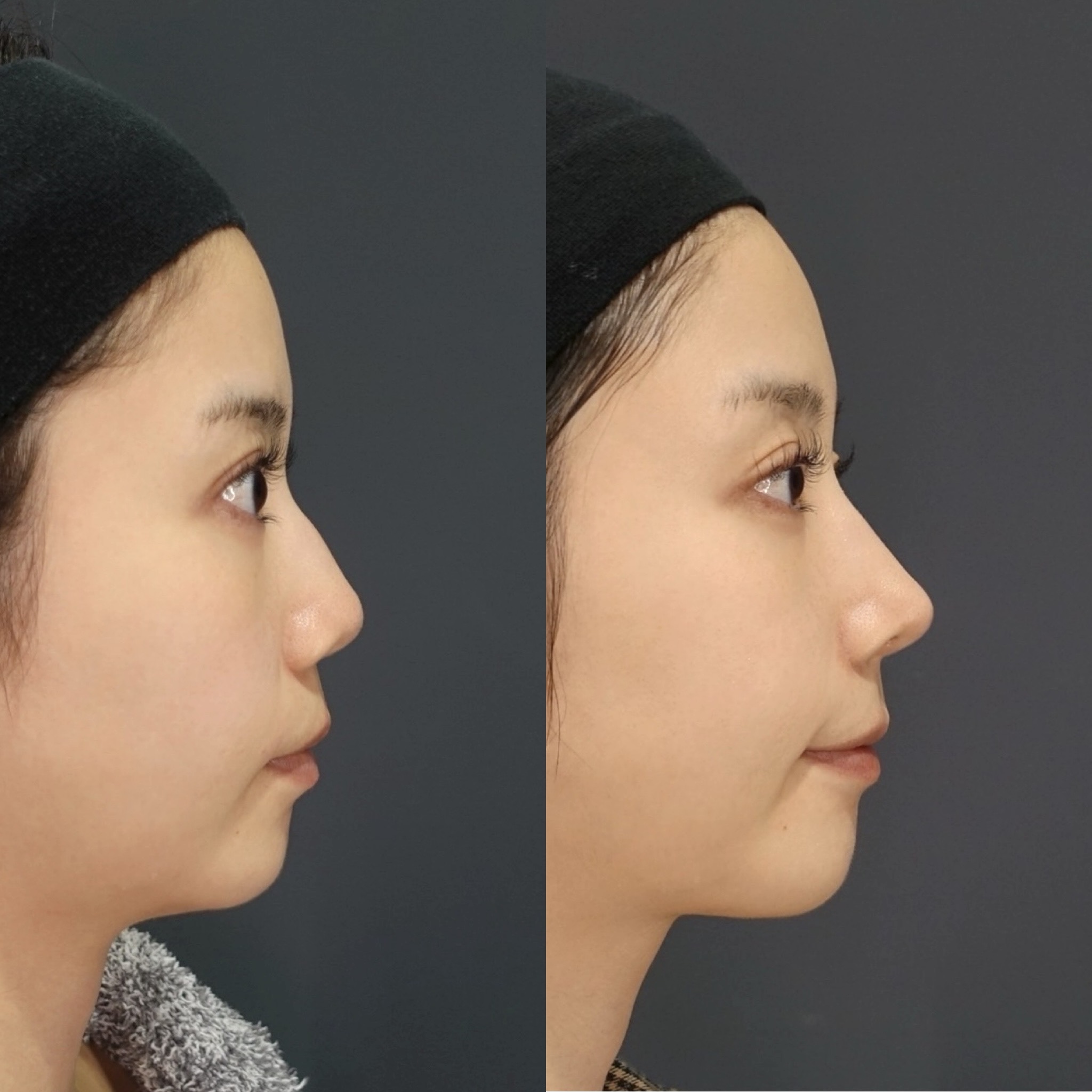 鼻のコンプレックスを自信に!LIVIN CLINIC新行内先生と考える後悔しない鼻整形の選び方|NERO DOCTOR / BEAUTY(美容医療)