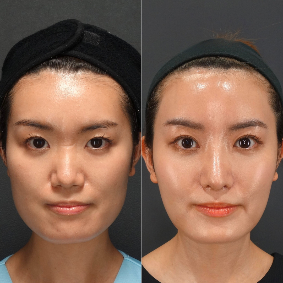 鼻のコンプレックスを自信に!LIVIN CLINIC新行内先生と考える後悔しない鼻整形の選び方|NERO DOCTOR / BEAUTY(美容医療)