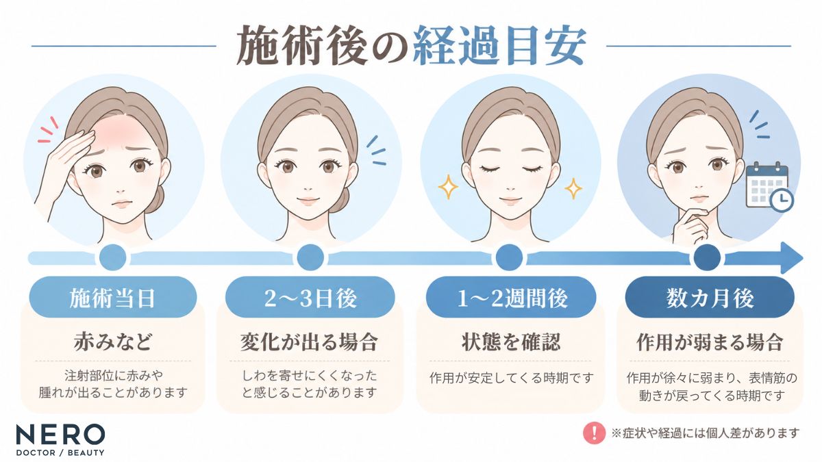 おでこのボトックス注射後の変化と経過の目安