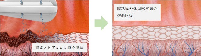 性交痛でヒリヒリ…その悩み、治療で解決できるって知ってた？名古屋・咲江レディスクリニックが行う婦人科美容的アプローチとは