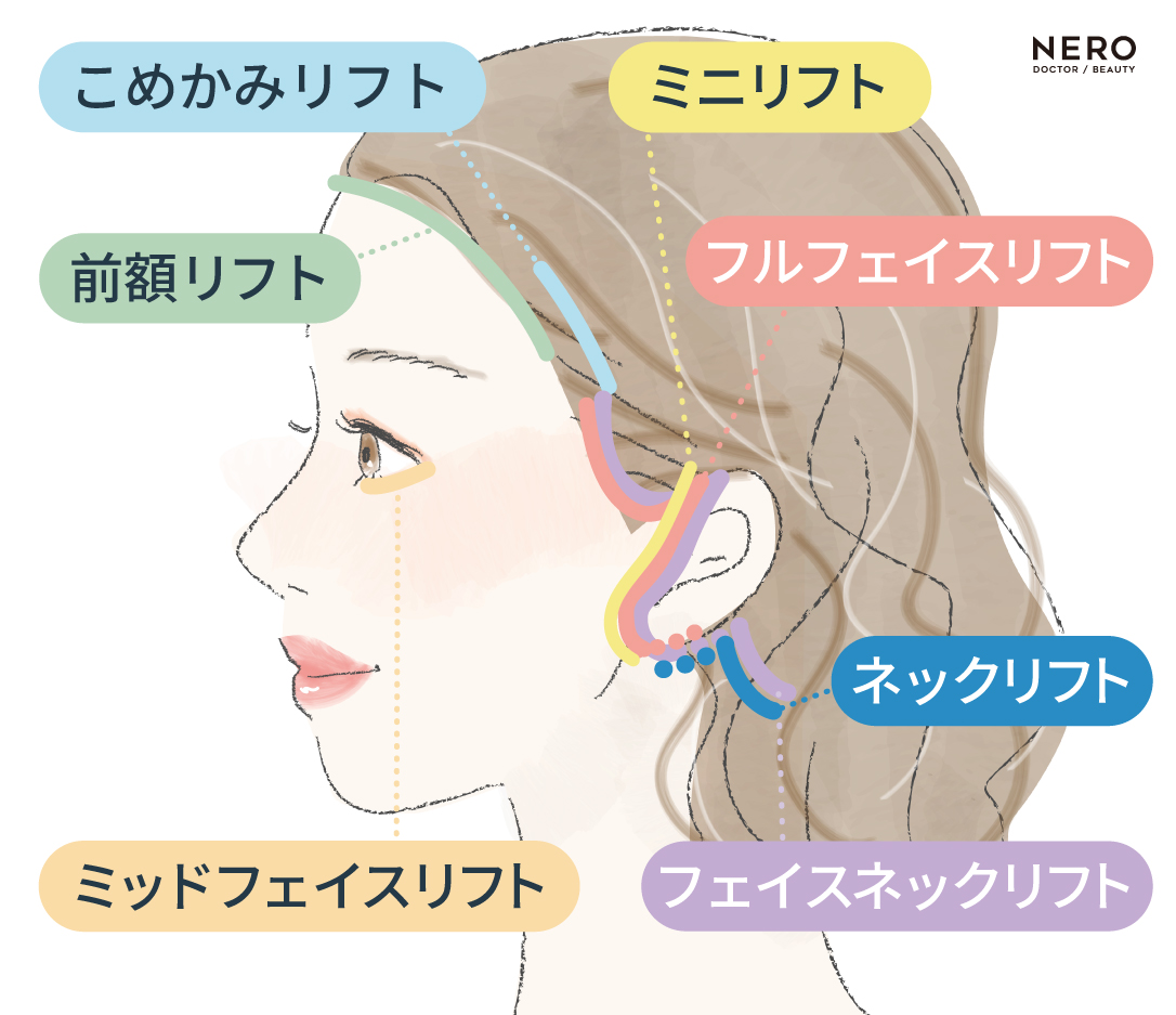 糸だけではもう限界…？「切開フェイスリフト」っていつから検討する？切開方法の違いによる特徴・各クリニックの施術方法の違いを解説
