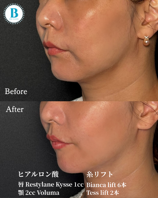 バンコクの美容クリニック「Bibi Clinic(ビビクリニック)」で日本クオリティの施術を体験