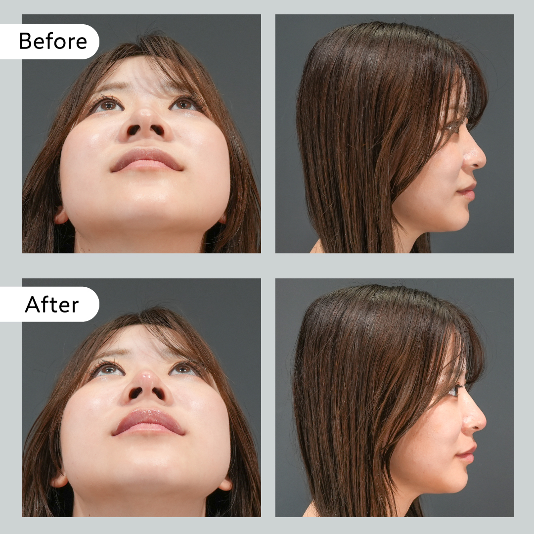 【BIANCA体験記事】本人の理想と医師の目線は違う？実際のカウンセリングと施術を徹底解剖！