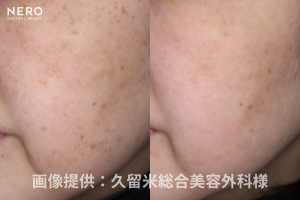 【シミ取り福岡】皮膚科と美容皮膚科、どちらを選べば良い？久留米総合美容外科のカスタマイズ治療™で肌悩みにトータルアプローチ！