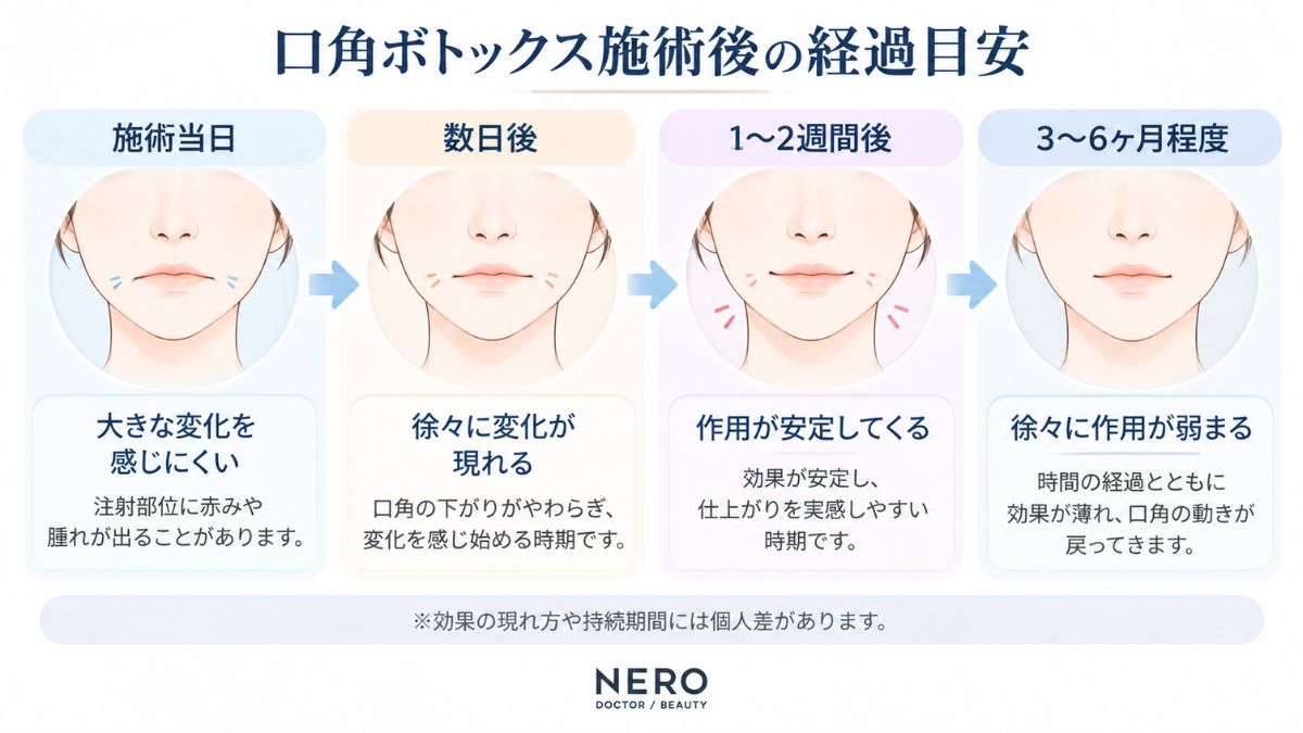 ボトックス口角注射後の変化と持続期間の目安を示す図