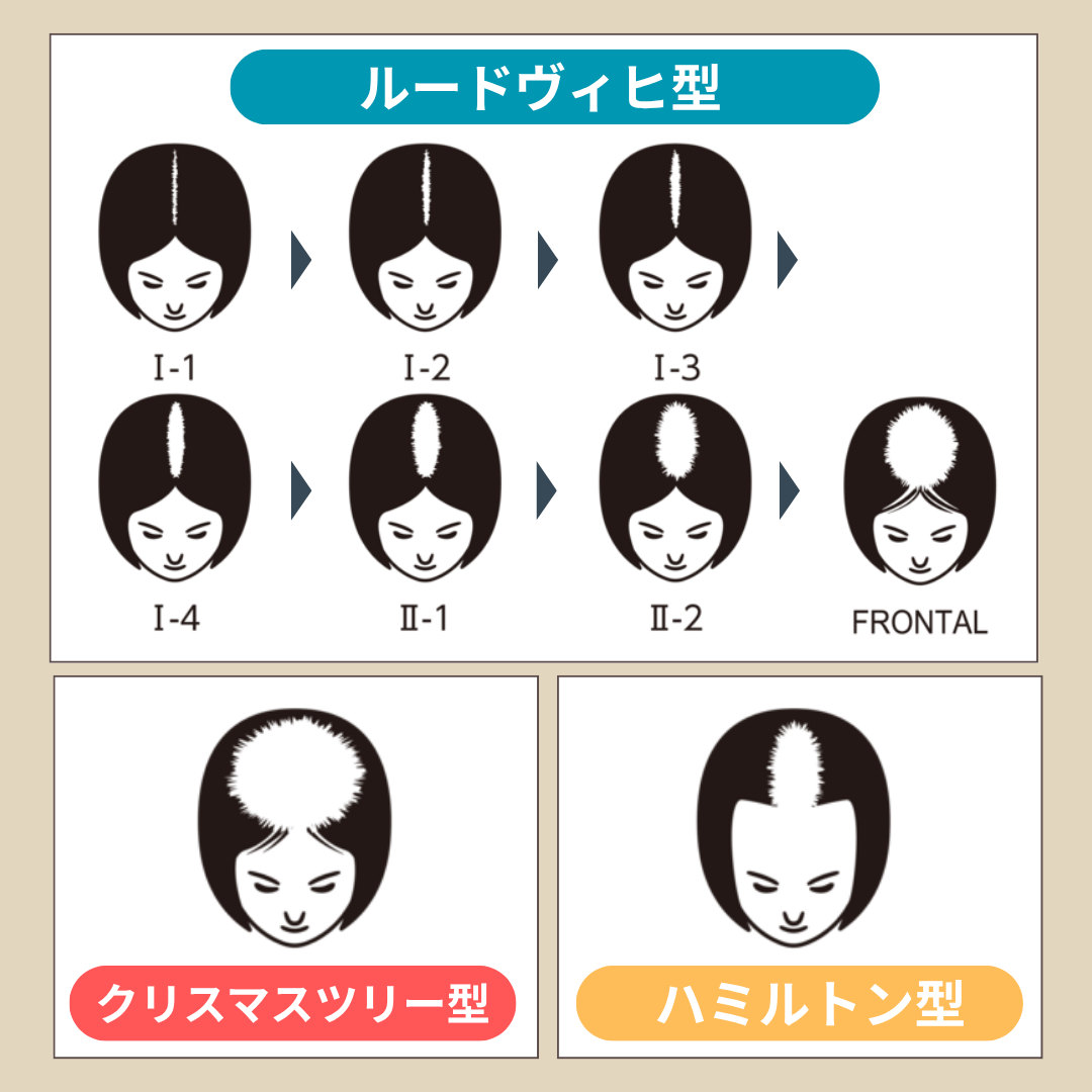薄毛の種類　分類図　再生医療×薄毛：女性の「FAGA治療」進化中 「まさか自分が」から始まる、30代女性の薄毛治療白書。 ―育毛サロンより効果的な、医療の選択肢とは？｜NERO DOCTOR / BEAUTY（美容医療）