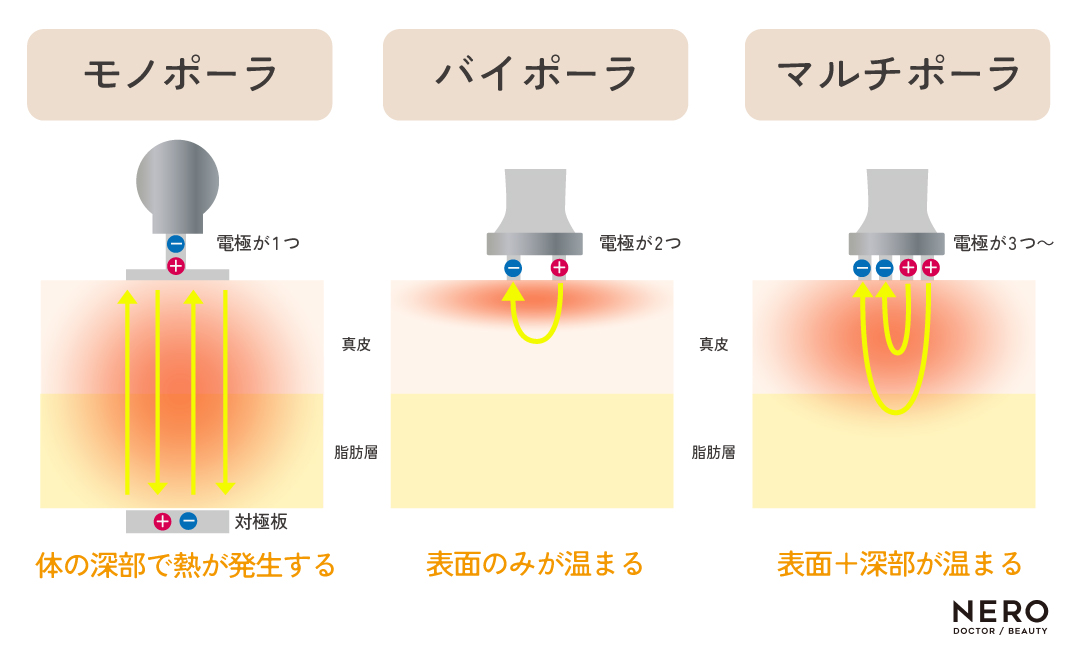 高周波（RF）機器の歴史と今後の予測｜NERO DOCTOR / BEAUTY（美容医療）
