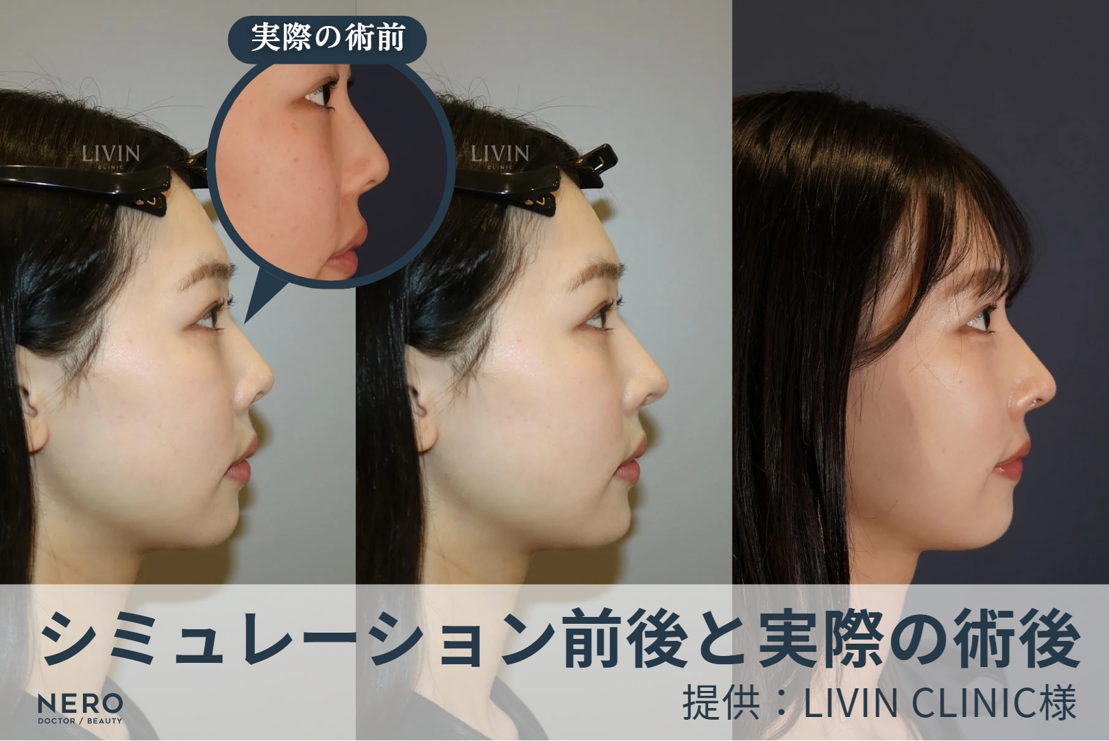 鼻のコンプレックスは鼻整形でどう変わる? LIVIN CLINICのリアルなシミュレーションで理想の鼻を見つける