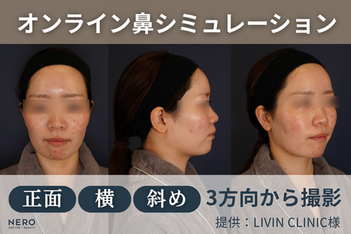 鼻のコンプレックスは鼻整形でどう変わる？ LIVIN CLINICのリアルなシミュレーションで理想の鼻を見つける