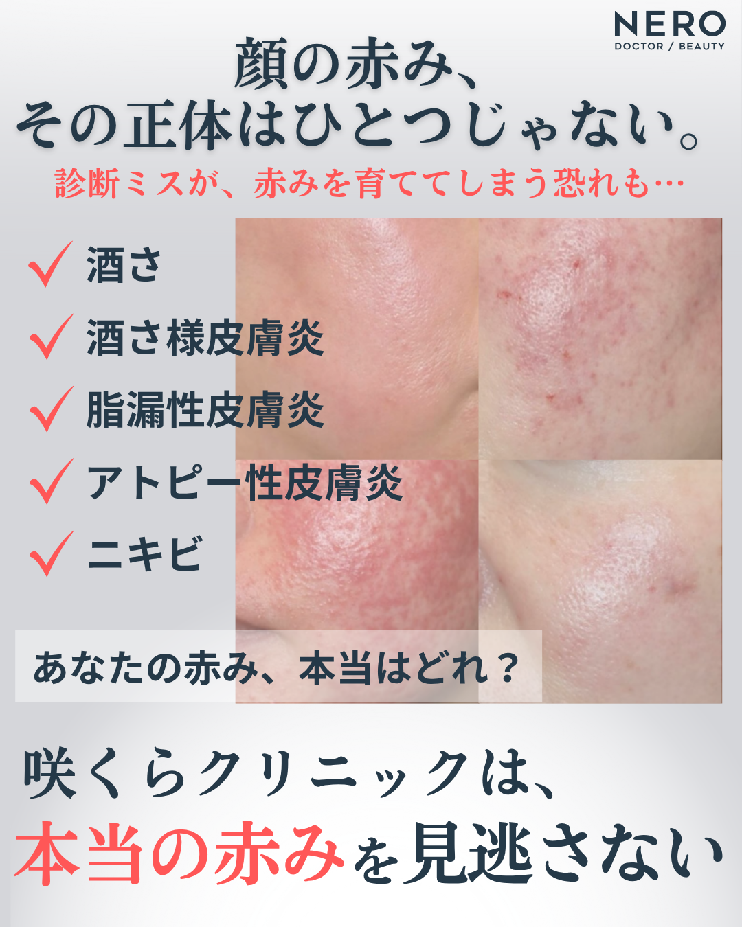 顔の赤みの原因は酒さとは限らない！診断がつかない赤みに向き合う咲くらクリニックの治療方針とは