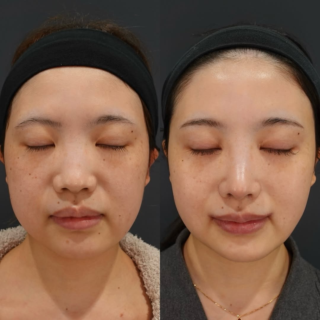 鼻のコンプレックスは鼻整形でどう変わる? LIVIN CLINICのリアルなシミュレーションで理想の鼻を見つける