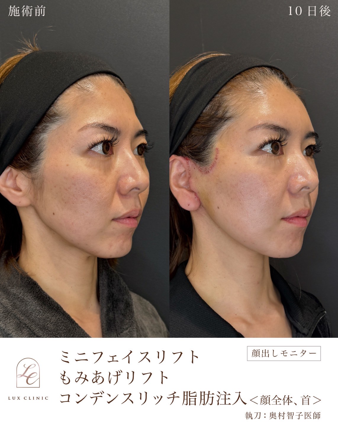 エイジングケアは何歳から?“老け見え”の悩みが深まる30代40代へ自然で美しい変化をもたらすルクスクリニックの選択肢を