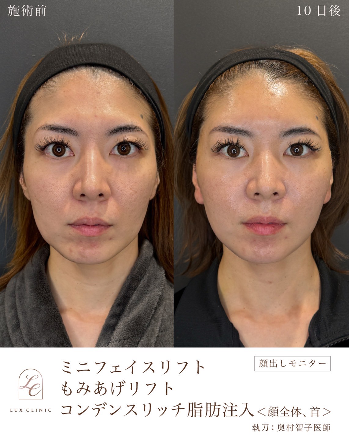 エイジングケアは何歳から?“老け見え”の悩みが深まる30代40代へ自然で美しい変化をもたらすルクスクリニックの選択肢を