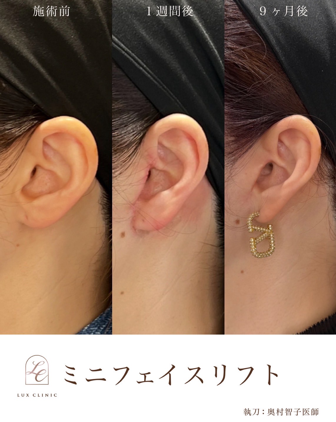 エイジングケアは何歳から?“老け見え”の悩みが深まる30代40代へ自然で美しい変化をもたらすルクスクリニックの選択肢を