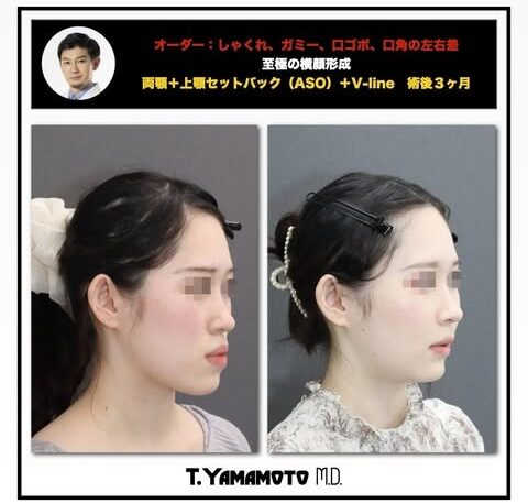 ルフォー術とSSROの違いは?輪郭矯正の名医“骨切り山ちゃん”に聞く施術選びの秘訣とは