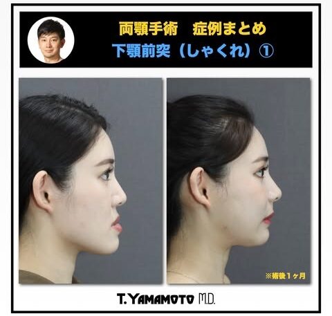 ルフォー術とSSROの違いは?輪郭矯正の名医“骨切り山ちゃん”に聞く施術選びの秘訣とは