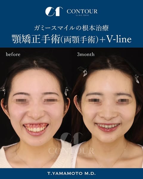ルフォー術とSSROの違いは?輪郭矯正の名医“骨切り山ちゃん”に聞く施術選びの秘訣とは