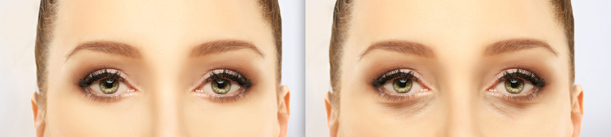 Achieve Brighter, Youthful Eyes with Tear Trough Fillers in Japan