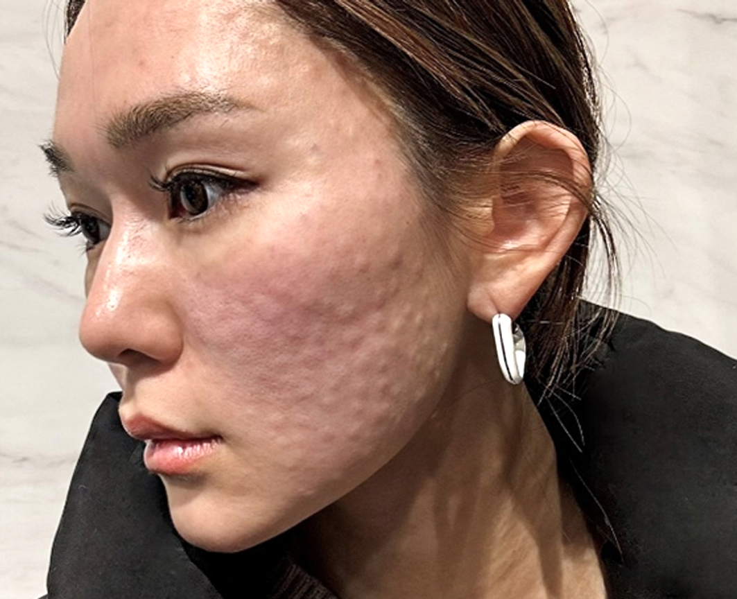 肌育注射の違いが分かる！人気スキンブースターの効果・成分・打ち方を解説｜NERO DOCTOR / BEAUTY（美容医療）