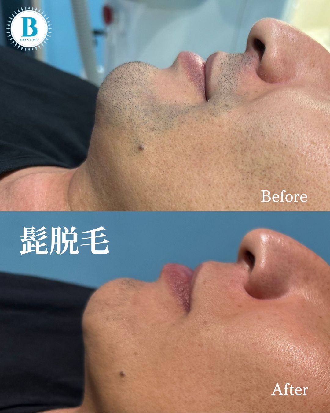バンコクでは脱毛が当たり前！美容クリニックBibi Clinicで男女とも全身ケア