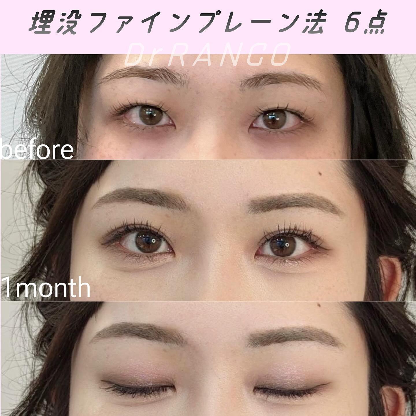 まぶたのたるみ取りは切る?切らない?オーキッド美容クリニック東京御徒町が提案する20代からの垢抜け二重整形・40代からの若見え二重整形