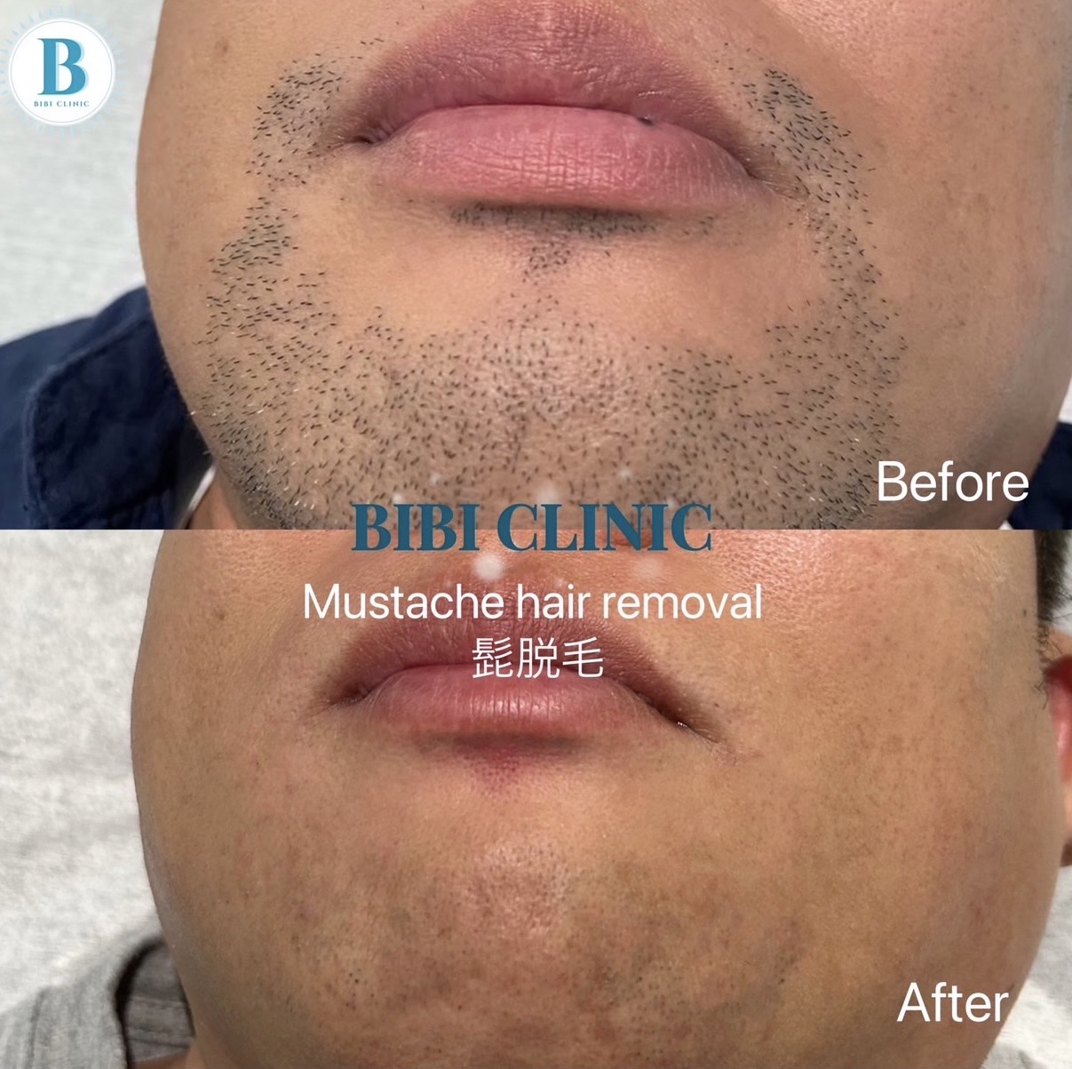 バンコクでは脱毛が当たり前！美容クリニックBibi Clinicで男女とも全身ケア