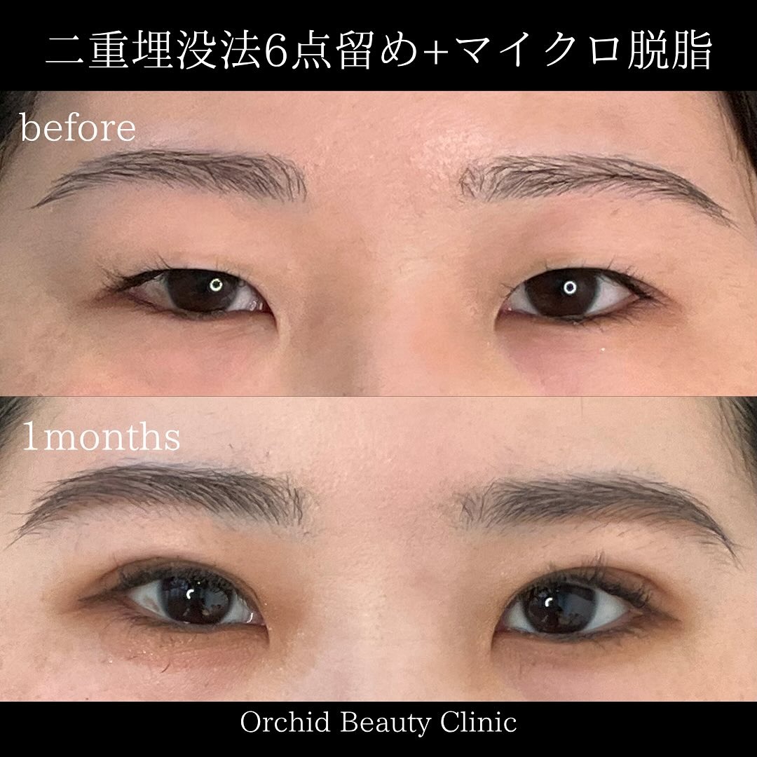 まぶたのたるみ取りは切る?切らない?オーキッド美容クリニック東京御徒町が提案する20代からの垢抜け二重整形・40代からの若見え二重整形