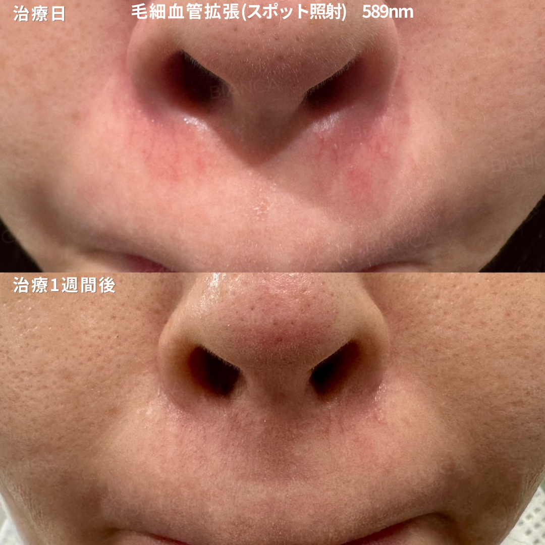 赤み・ニキビ・肌質改善を1台でケアできる【アドバテックスレーザー】をGlobal KOLが解説！ダウンタイムを気にしない“次世代”の肌育施術とは