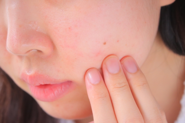 女性の頬アップ　アドバテックスレーザーを徹底解説！赤みやニキビの改善を目指せる理由とは？｜NERO DOCTOR / BEAUTY（美容医療）