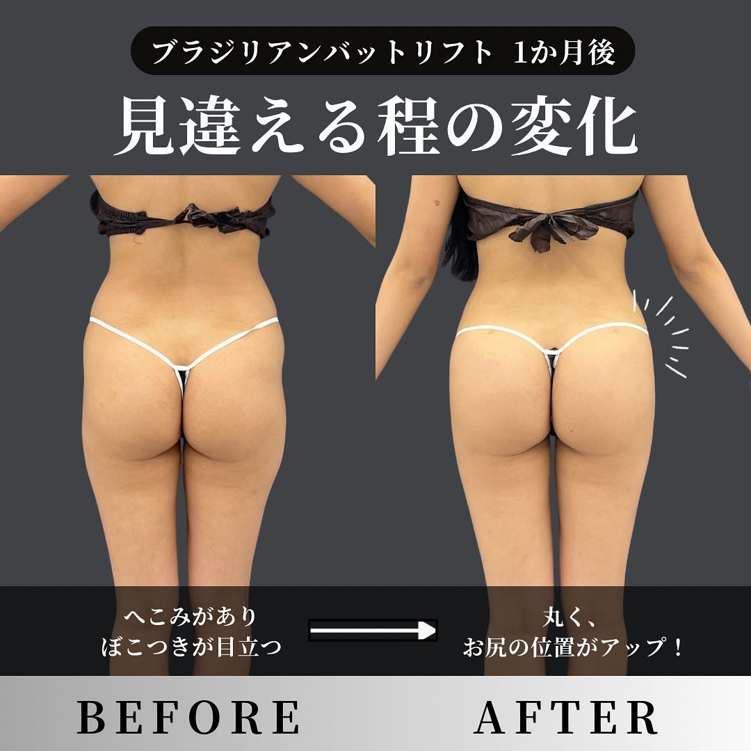 美尻の作り方2 ～「年齢なんてただの数字」豊尻術ブラジリアンバットリフトで40代から始めるお尻のアンチエイジング～【ロシッククリニック銀座 小野院長監修】