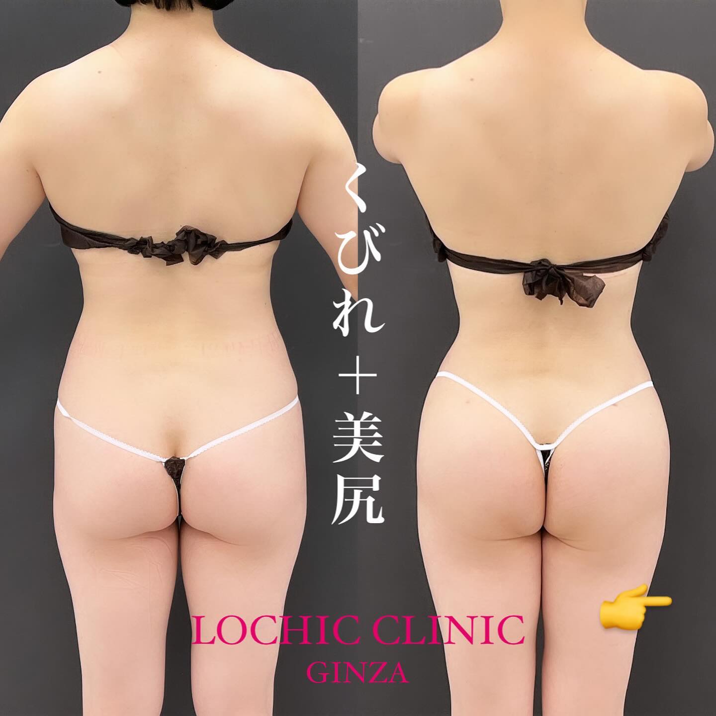 美尻の作り方2 ～「年齢なんてただの数字」豊尻術ブラジリアンバットリフトで40代から始めるお尻のアンチエイジング～【ロシッククリニック銀座 小野院長監修】